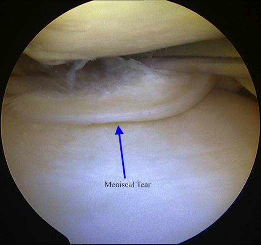 Meniscus Tear